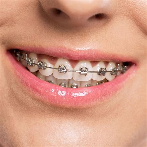 teeth white braces metal brackets|rectangular metal bracket.